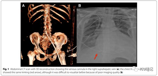VA-ECMO静脉管路的头端误入肝静脉
