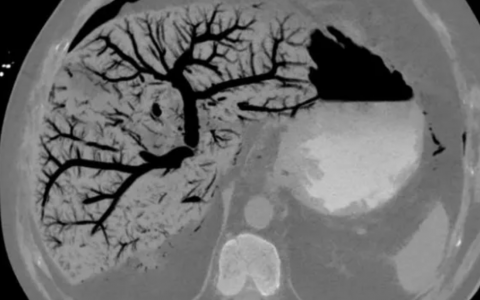门静脉积气影像学表现