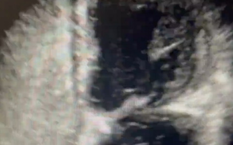 诡异--"气泡 "在左心室内移动