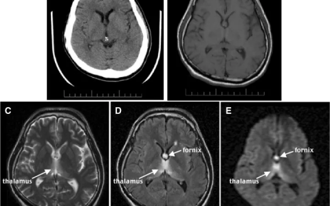 Wernicke-Korsakoff综合征