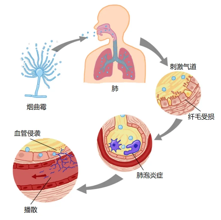 重症监护病房中的侵袭性肺曲霉菌病:当前的挑战和最佳实践