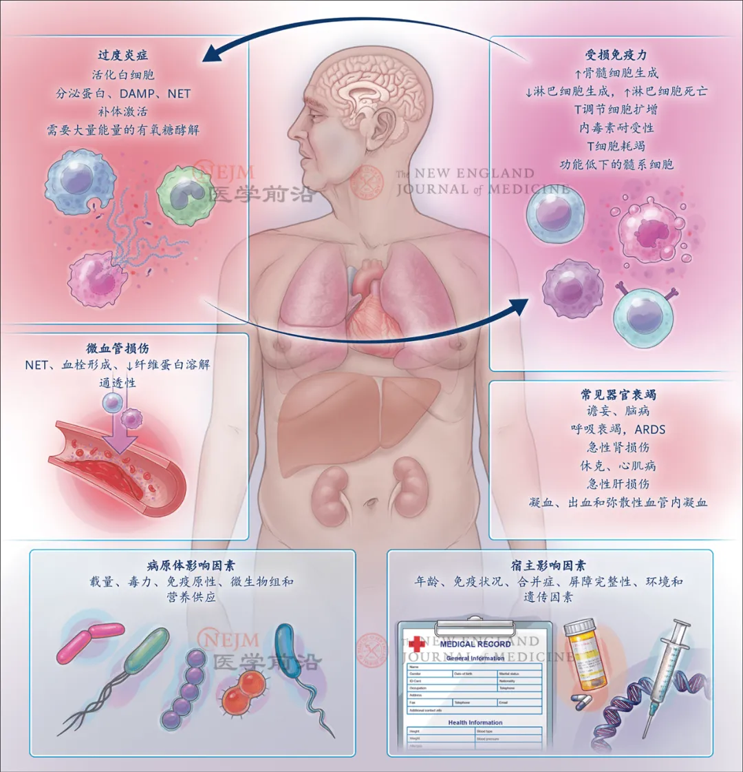 NEJM综述：脓毒症和感染性休克