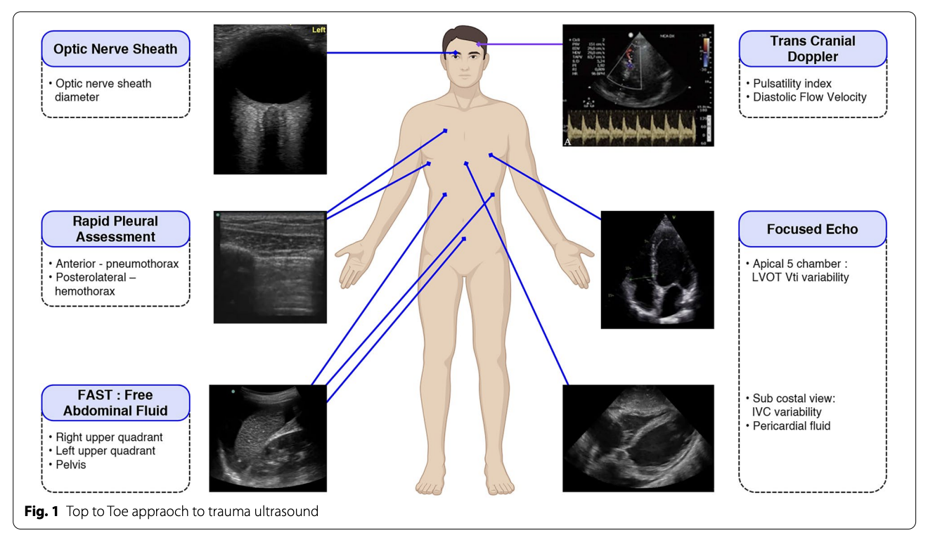 快速从头到脚的床边超声（POCUS）