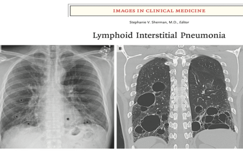 NEJM:淋巴细胞性间质性肺炎