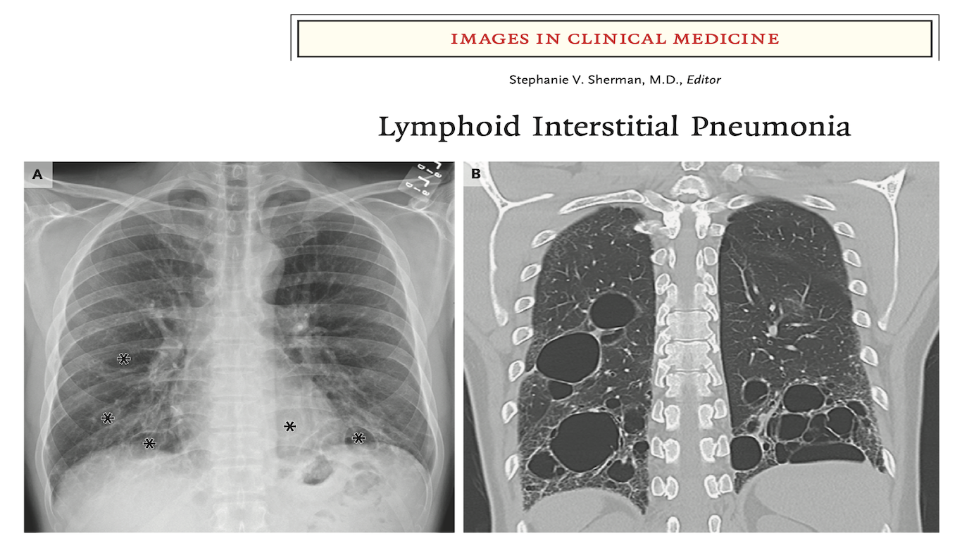 NEJM:淋巴细胞性间质性肺炎