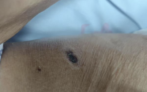 发热疼痛4天