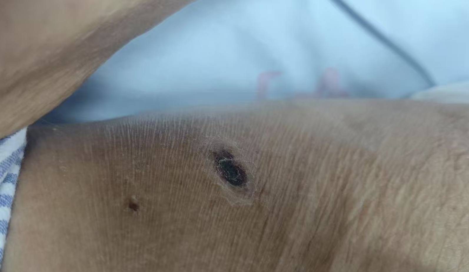 发热疼痛4天