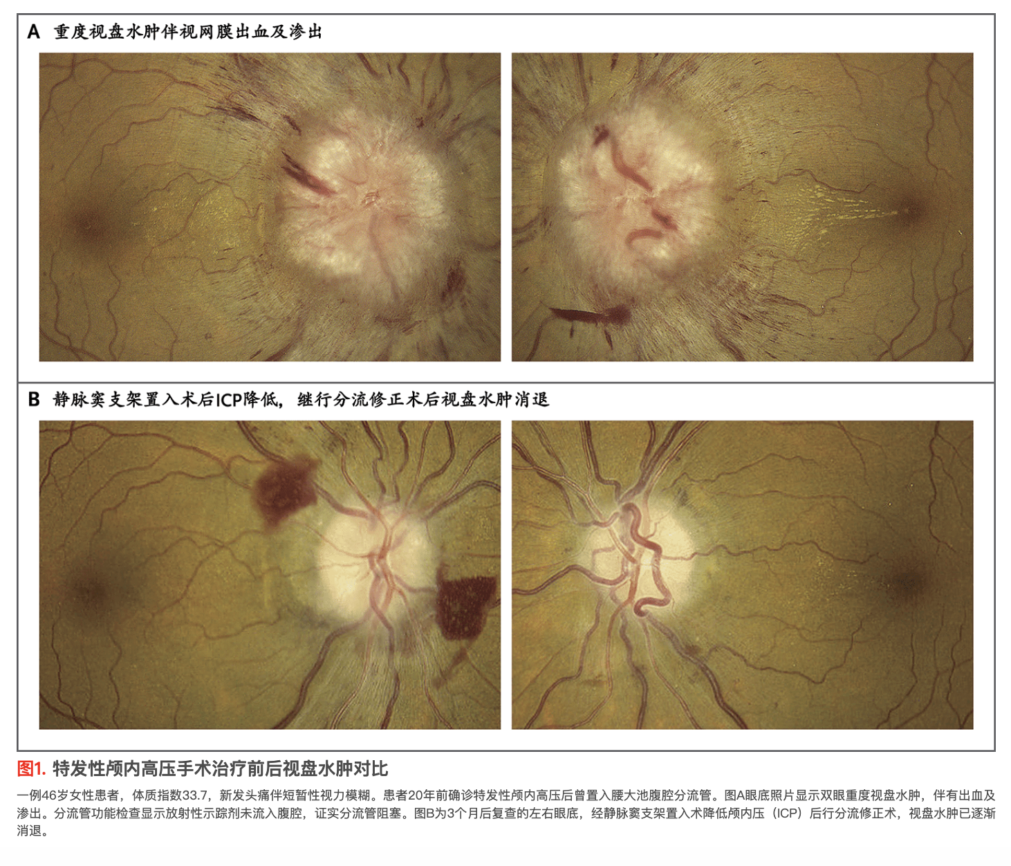 NEJM:特发性颅内高压