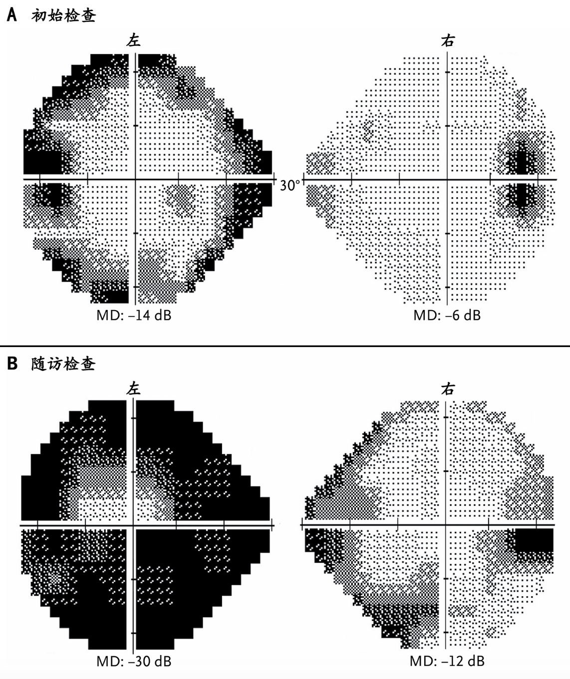 NEJM:特发性颅内高压