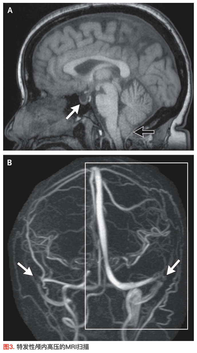 NEJM:特发性颅内高压
