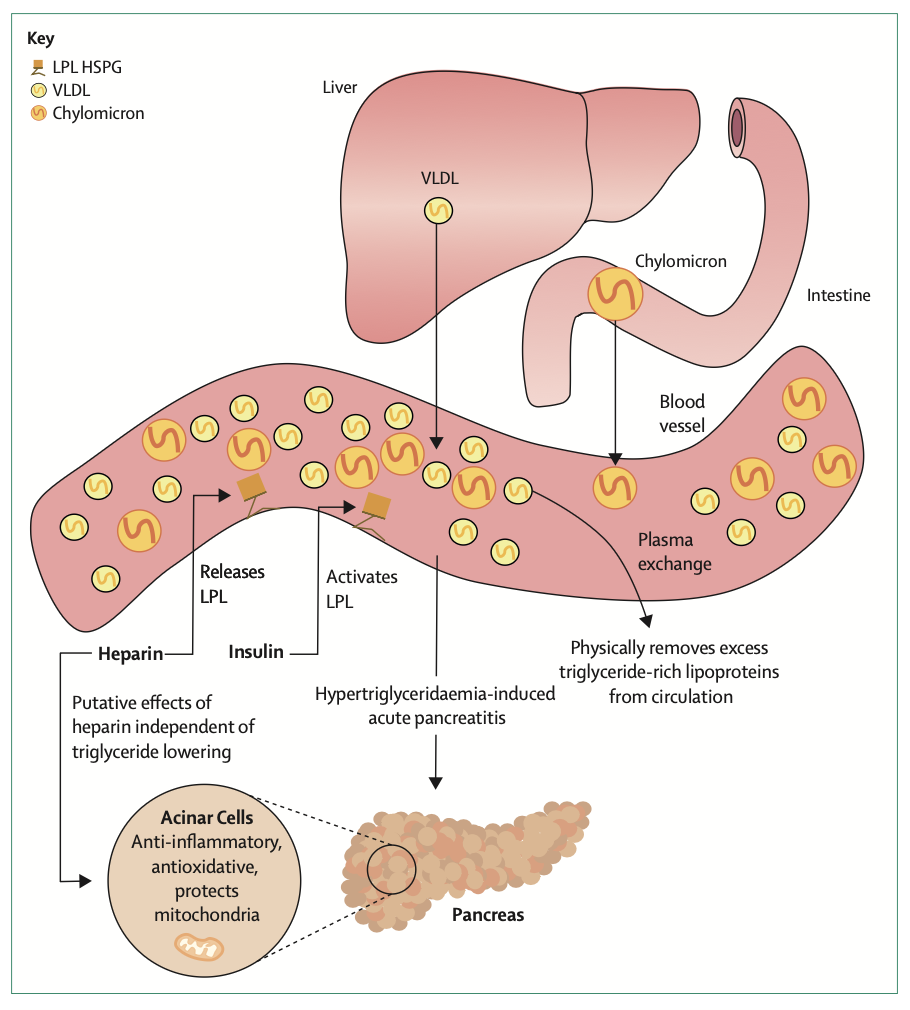 Lancet Diabetes Endocrinollancet：高甘油三酯性胰腺炎——降不降脂？
