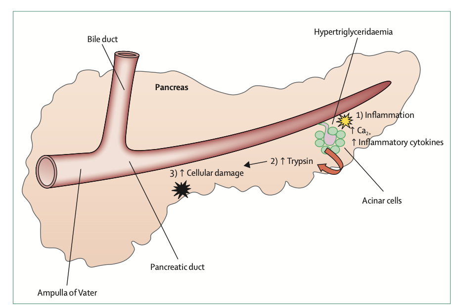 Lancet Diabetes Endocrinollancet：高甘油三酯性胰腺炎——降不降脂？