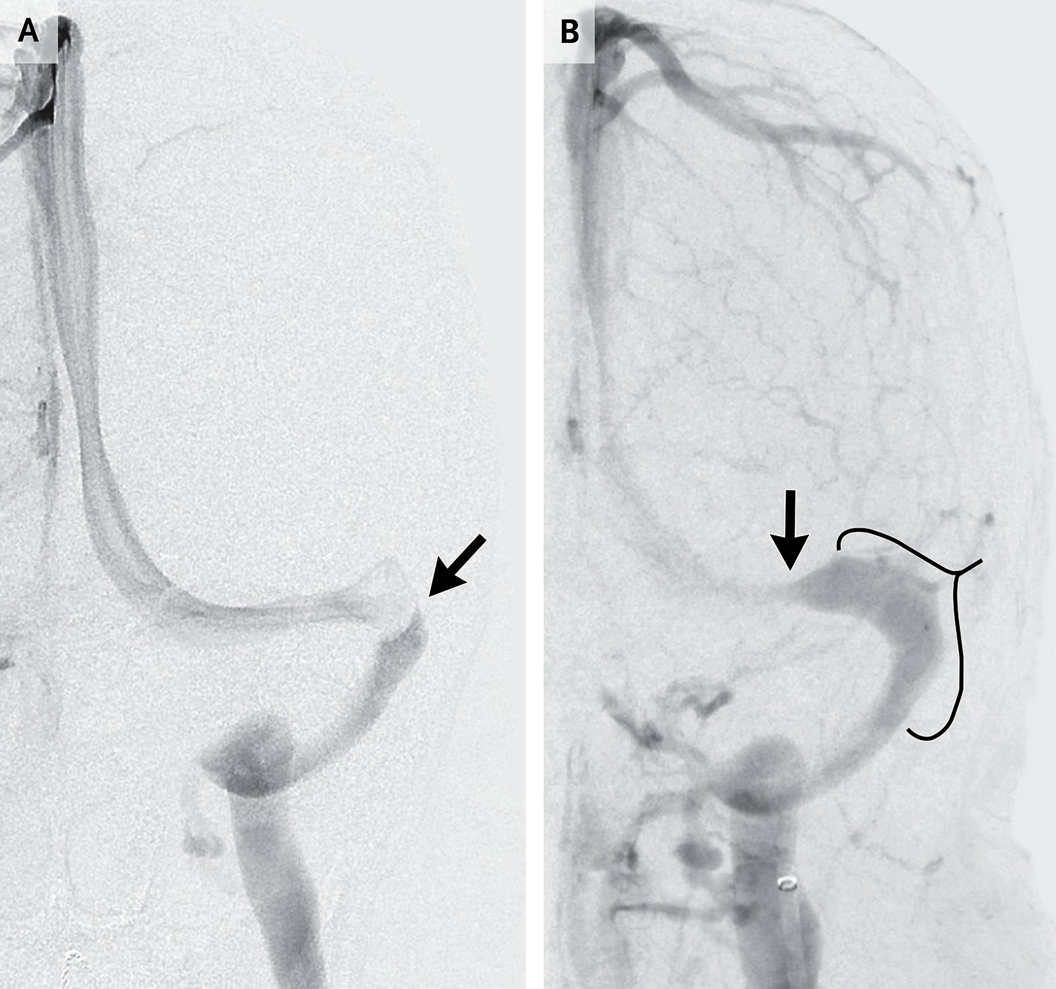 NEJM:特发性颅内高压