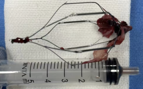 VA-ECMO在高危肺栓塞中的临床应用