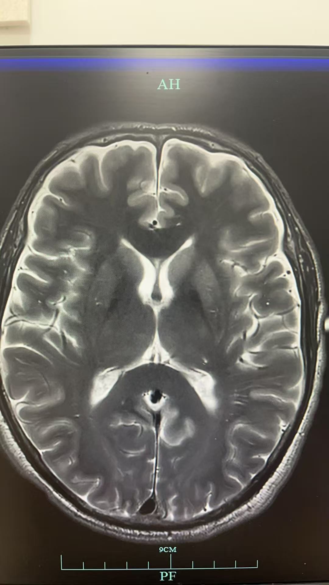 男性，59岁，意识障碍待查