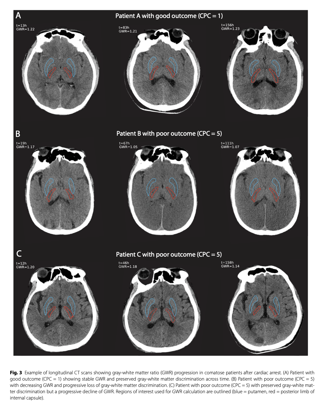 CC:心脏骤停后结果预测的自动灰质-白质比纵向评估