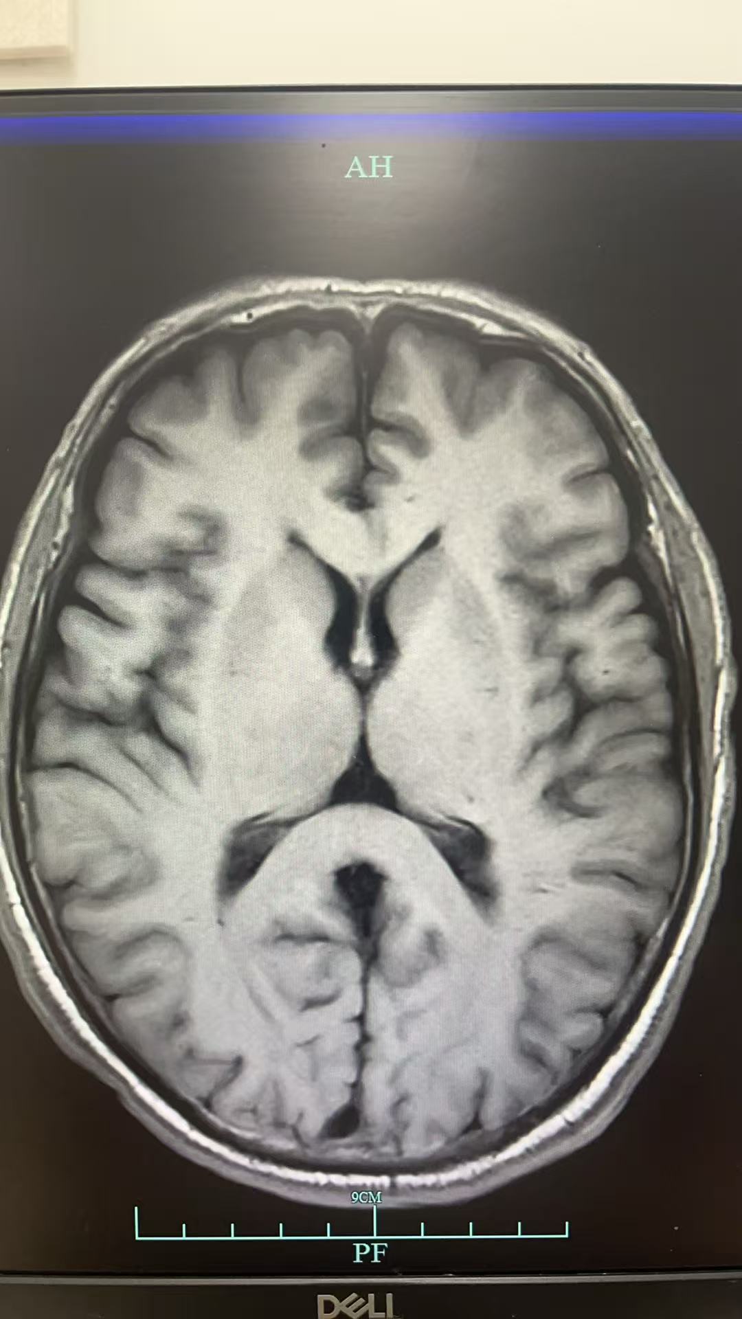 男性，59岁，意识障碍待查