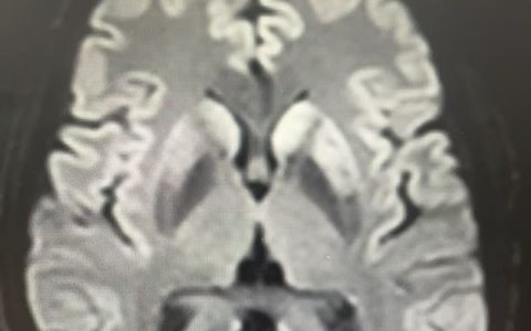 意识障碍待查：克-雅病