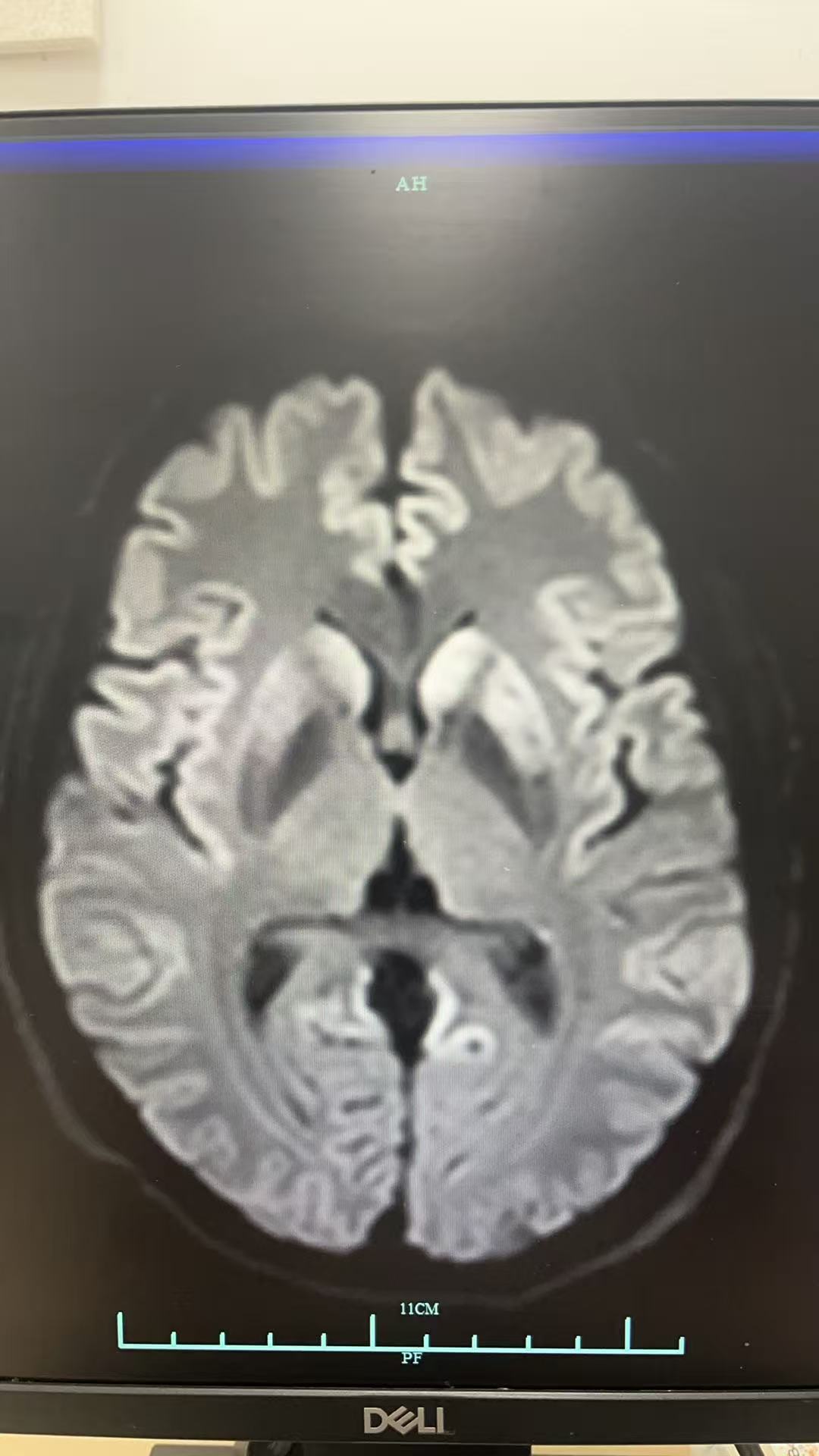 男性，59岁，意识障碍待查