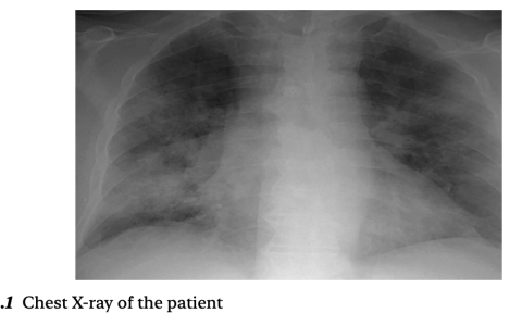 夜猫子读书日记：第一章：气道管理