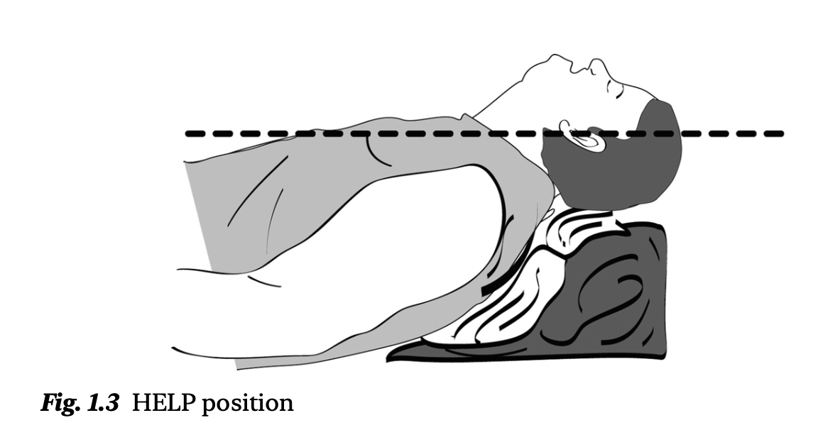 夜猫子读书日记：第一章：气道管理