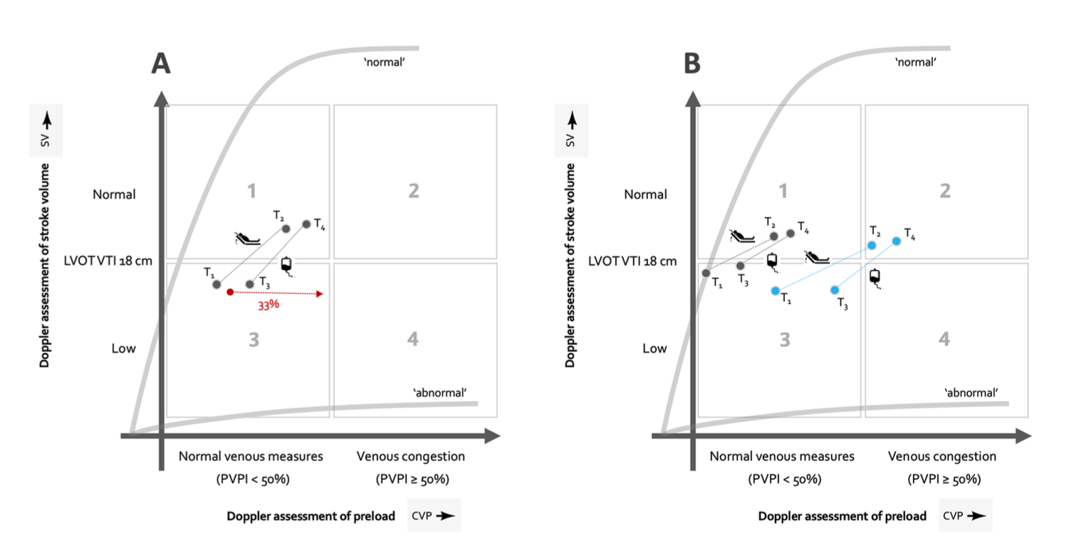 CC:被动抬腿试验揭示静脉淤血：动态液体不耐受与多普勒Starling曲线