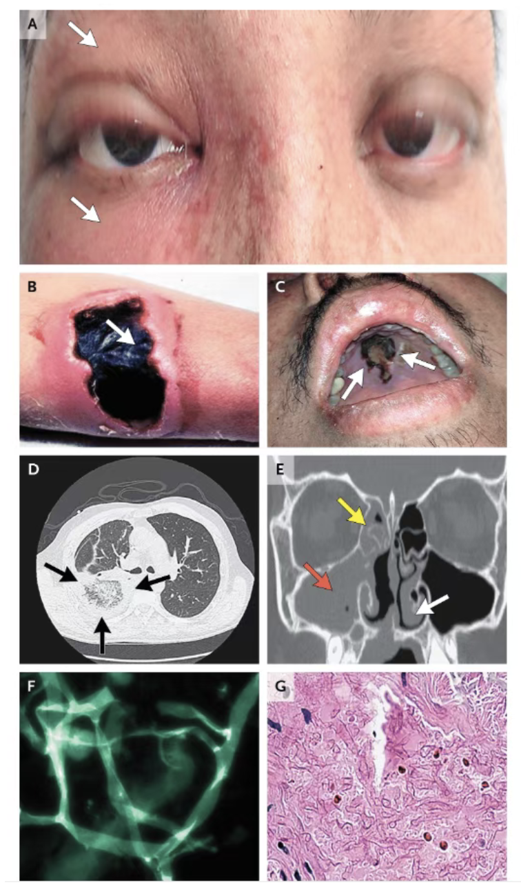 NEJM综述：毛霉菌病